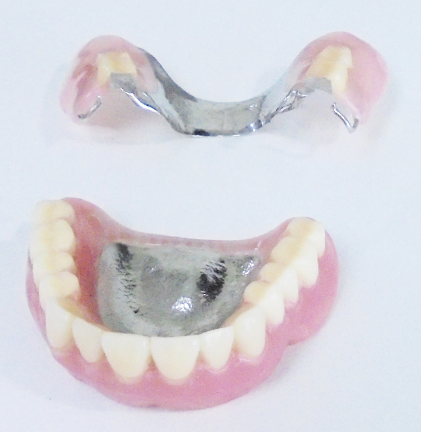 自費の金属床義歯